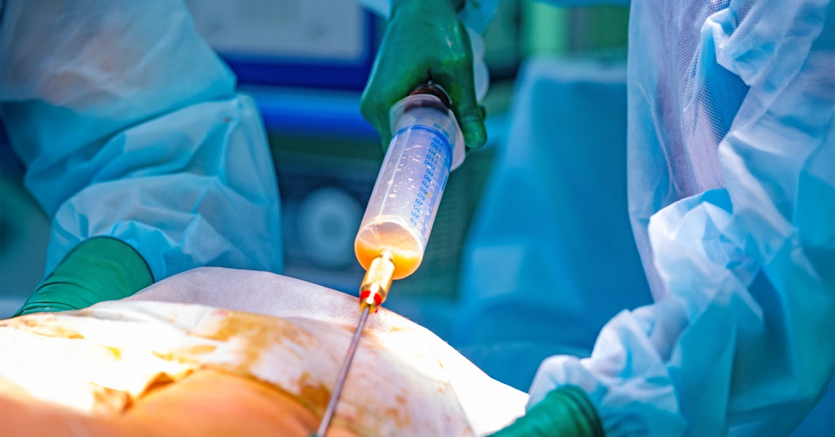 Fat removal during liposuction treatment at Medlounges
